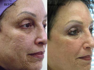 CO2 skin rejuvenation
