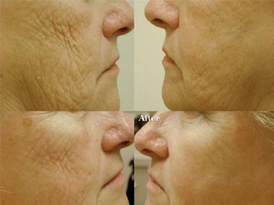 Fractional CO2 skin rejuvenation