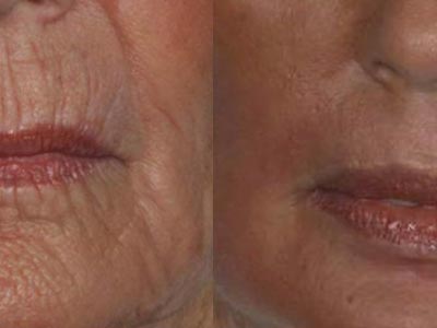 Fractional CO2 skin rejuvenation photos