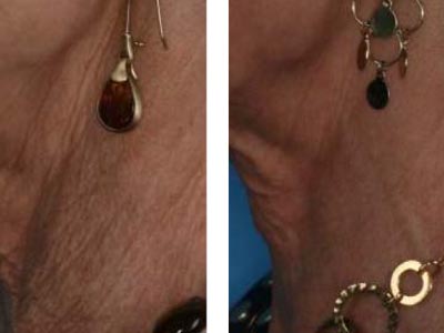 CO2 skin rejuvenation