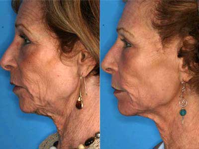 CO2 skin rejuvenation