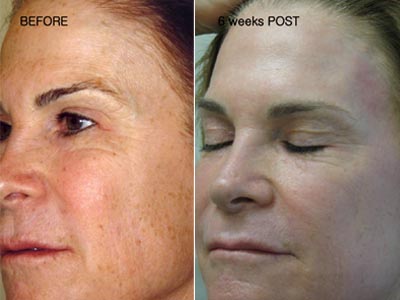 CO2 skin rejuvenation