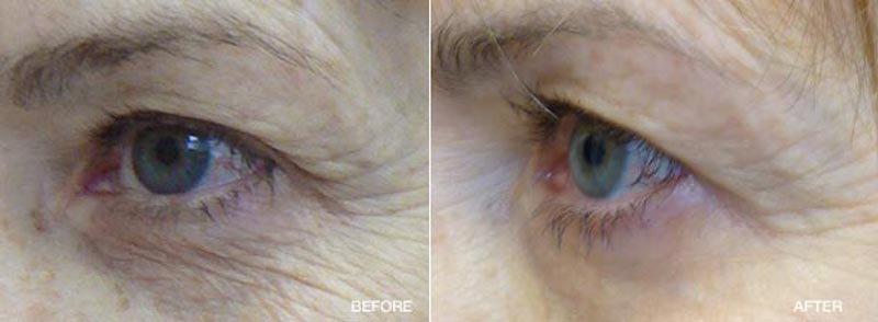 Pelleve Before and Afters