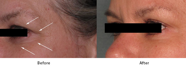 Pellevé before and after photos