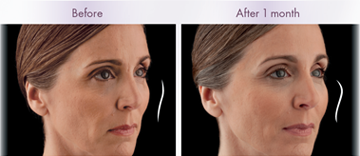 voluma before and after photos